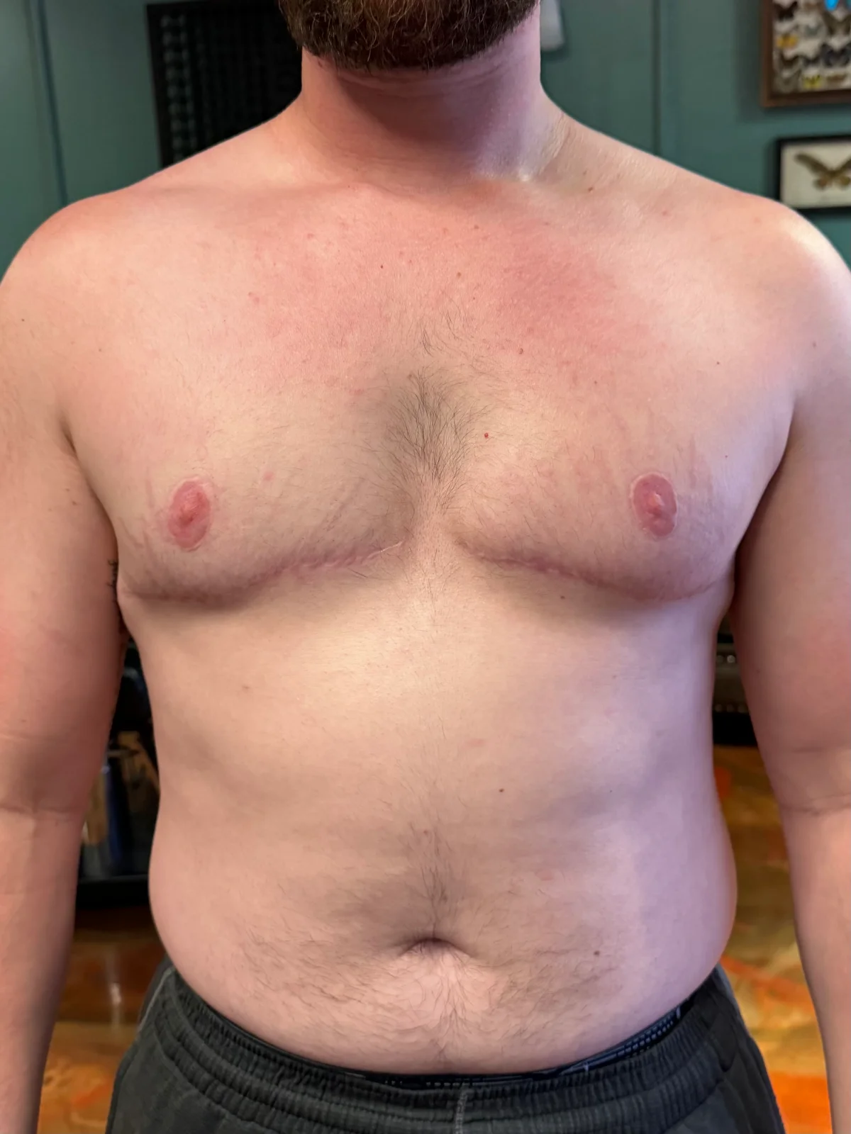 Upper body with visible scar from surgery
